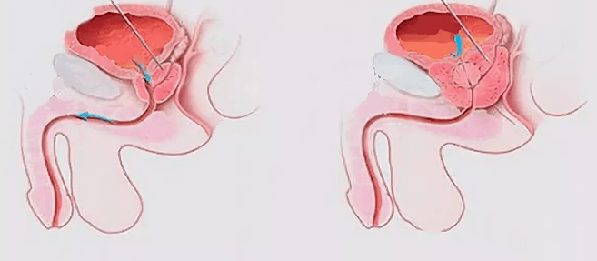 Prostatitis signs in men