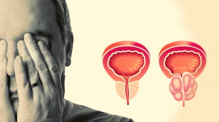 There is a person's prostatitis