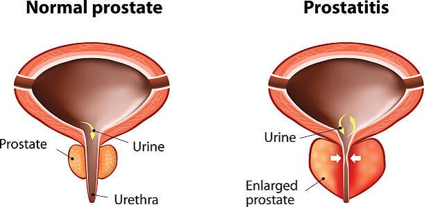 normal and inflammatory prostate