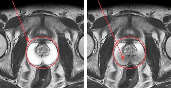 Normal prostate (left) and inflammation of the prostate with prostatitis (right)